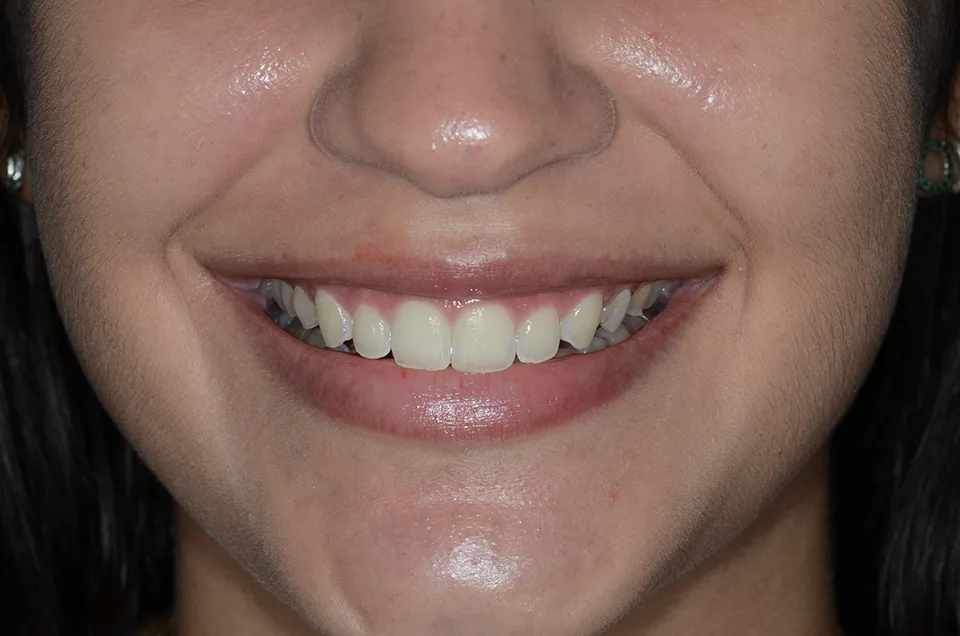 Antes